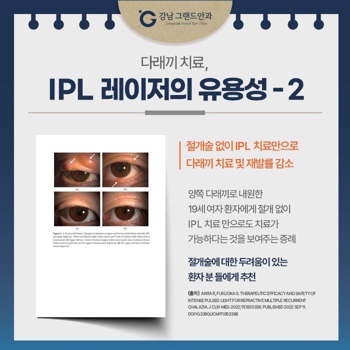 강남역 다래끼 치료 수술 아닌 IPL 중요한 이유 사진 12