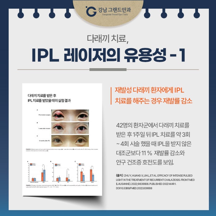 강남역 다래끼 치료 수술 아닌 IPL 중요한 이유 사진 10