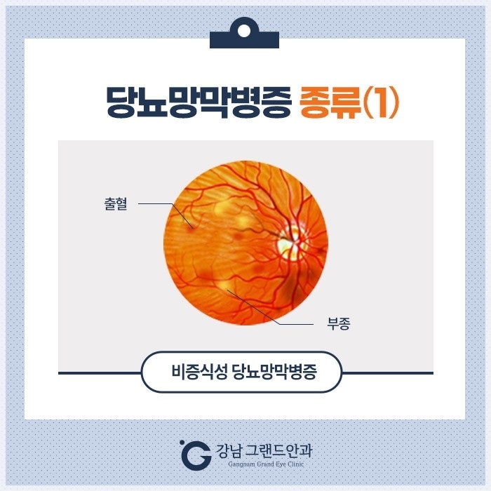 강남 당뇨망막병증 증상 레이저 수술 주사 치료 안과 사진 4