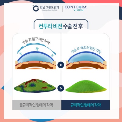 난시 각막 손상 증상 어떤 시력 교정 수술을? 사진 5