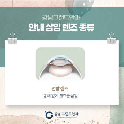 ICL 렌즈삽입술 수술 강남 병원 사진 5