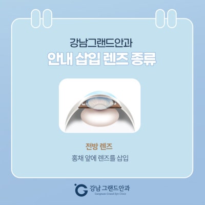 ICL 수술 비용 비싼 이유는? 사진 4
