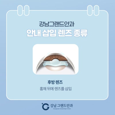 ICL 수술 비용 비싼 이유는? 사진 5
