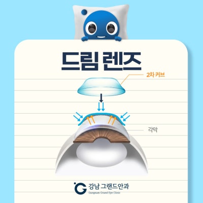 강남역 드림렌즈 안과 초등학생 근시교정 부작용 알아보자! 사진 3