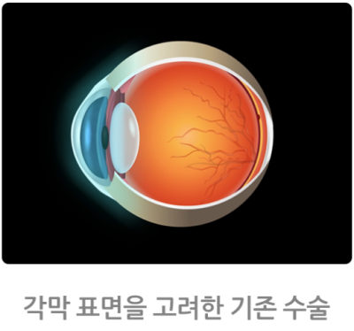 퍼스널아이즈,기존 시력교정과 어떤 차이점이 있을까요?