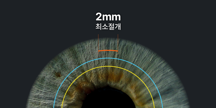 스마트라식? 스마일라식? 사진 6