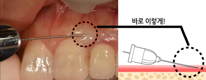 치과 통증, 안 아프게 치료 받는 법_치과마취주사/치과 무통 마취_치과 안아프게 치료 할 수 있을까? 사진 3