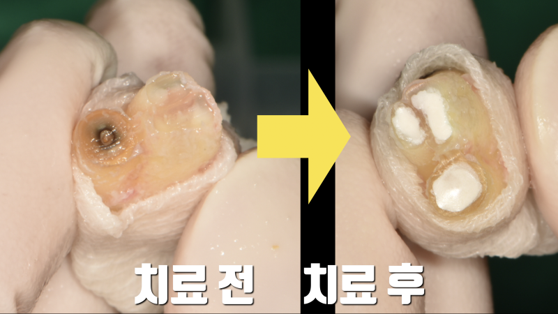 서울에서 포기한 치아 재식술로 살리기