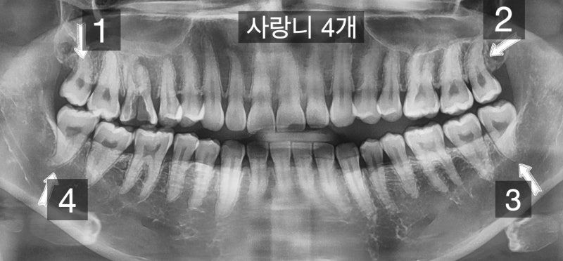 완전 파절치아의 치료, 파절치아 재식술 #치아재식술 #의도적재식술