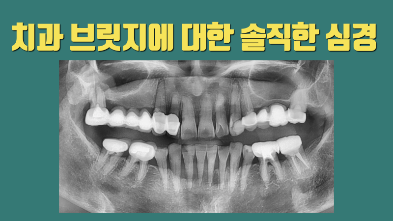 브릿지를 하게 되면 최대한 인생의 후반부에 하셔야 합니다 #치아살리기 #치아재식술