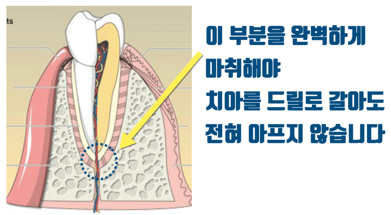 이 이상의 치과 마취는 없다 ! 골내 마취 + 다단계 마취법 #무통마취 #최용훈원장 사진 2