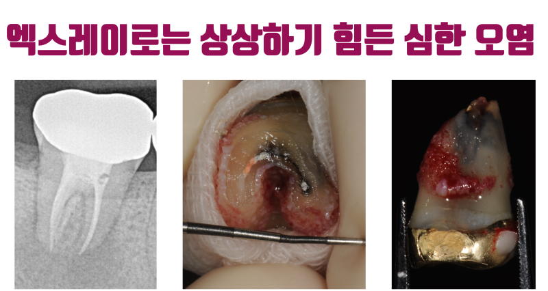 오염 심한 치아 재식술 10년 경과 증례 #재식술 #치아재식술 #최용훈원장 사진 2