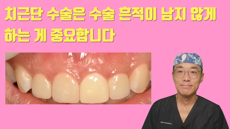 치근단 수술(치근 절제술)은 흔적이 남지 않게 흉터가 남지 않도록 하는게 중요합니다 #치근단수술 #치근절제술 #최용훈원장