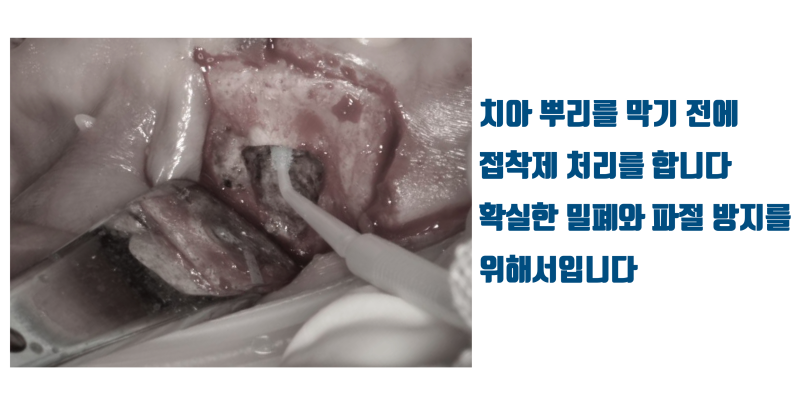 치근단 수술 재발 방지를 위해서 접착 치료를 추천 #치근절제술 #치근단수술 #최용훈원장