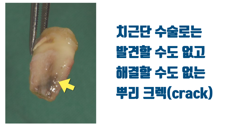 치근 절제술(치근단 수술) 실패한 치아에서 배우는 치근단 수술 추천하지 않는 이유 #치근절제술 #재식술 #최용훈원장