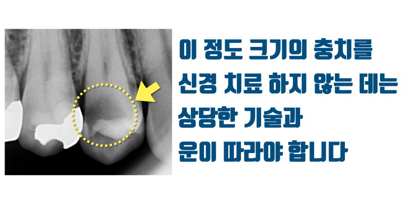 [소신 진료] 깊은 충치를 신경 치료, 크라운 하지 않은 경우 1년 경과 #접착세라믹 #치아살리기 #최용훈원장 사진 2