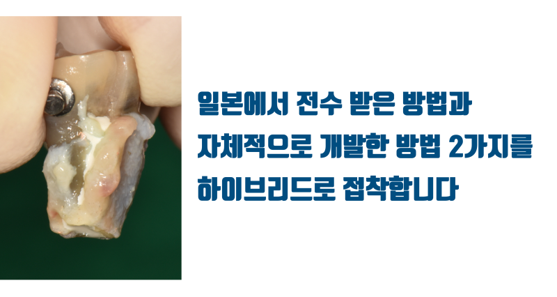 [가슴 벅찬 치아살리기] 완전히 쪼개진 치아를 살렸다! #재식술 #치아재식술 #최용훈원장