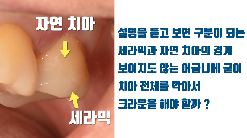 [소신 발언] 보이지도 않는 어금니에 굳이 치아를 많이 깍아서 크라운을 해야 할까요 ? #치아살리기 #최용훈원장