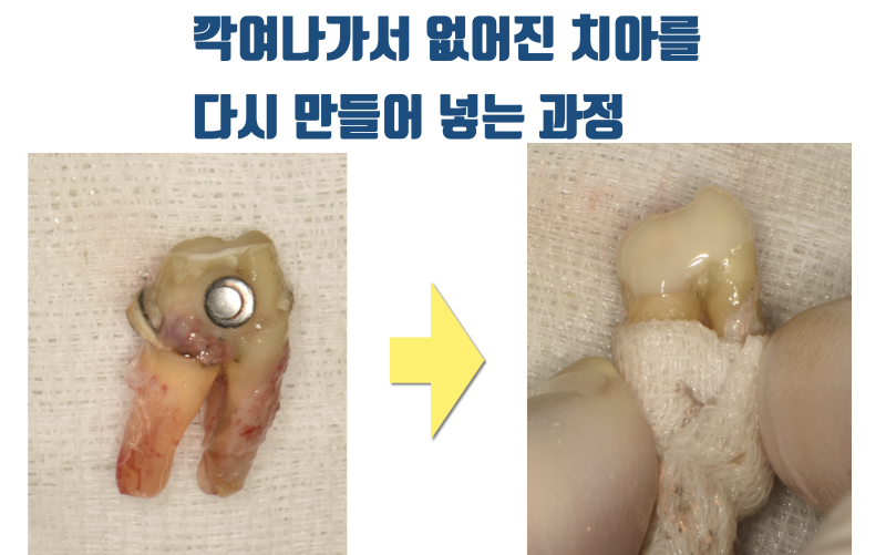 [안타까운 치아들] 기존 크라운이 너무 커서 어쩔 수 없이 재식술을 해야 하는 치아들 #재식술 #치아재식술 #최용훈원장