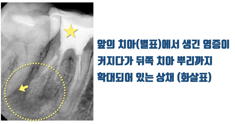 [어렵지만 보람있는 치근단수술] 옆 치아까지 번진 염증 치아의 치근단 수술 해결 #치근단수술 #치근절제술 #최용훈원장 사진 2