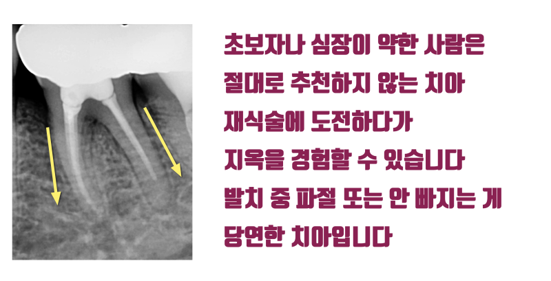 [이런 치아도 살렸다] 뿌리가 벌어진 발치가 어려움 + 크렉 치아의 재식술 치료 #재식술 #치아재식술 #최용훈원장 사진 2