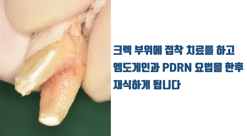 [이런 치아도 살렸다] 뿌리가 벌어진 발치가 어려움 + 크렉 치아의 재식술 치료 #재식술 #치아재식술 #최용훈원장