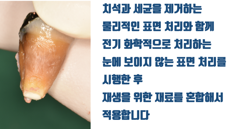 [역사적인 치아 살리기] 치조골이 완전히 무너진 치석 + 세균 덩어리 치아의 재생 치료 #재식술 #치아살리기 #최용훈원장 사진 4