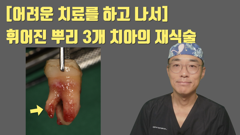 [보람있는 치료] 휘어진 뿌리 + 기둥까지 박힌 치아의 성공적인 치료 #재식술 #치아재식술 #최용훈원장