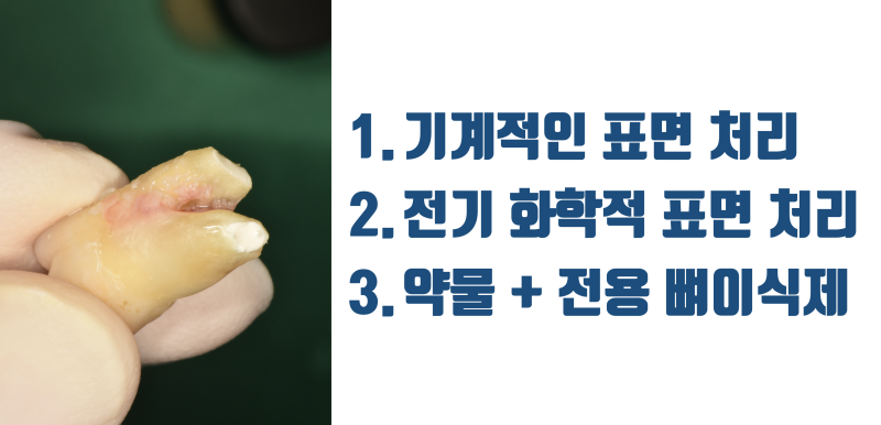 [역사적인 치아 살리기] 치석과 세균으로 발치 판정 받은 치아를 살리는 과정 #재식술 #치아살리기 #최용훈원장 사진 4