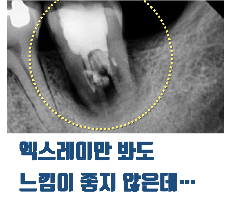 [환자도 의사도 X쳐야 하는 증례] 독일에서 치아 살리러 날라온 환자 스토리 #파절치재식술 #재식술 #최용훈원장 사진 3