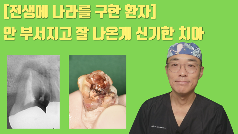 [하고 나서 놀란 치료] 신이시여 제가 이 치아를 안 부서지게 뽑았습니까 ? #재식술 #치아살리기 #최용훈원장