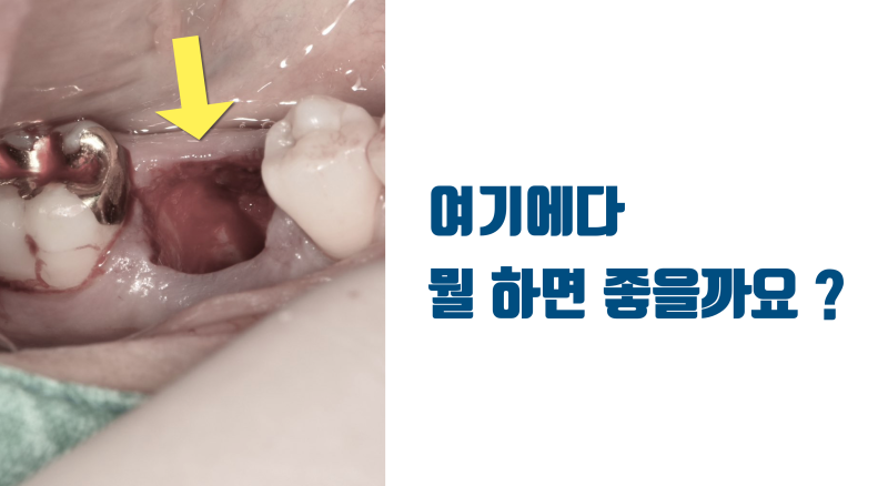 [치아 재생의 실제] 지금 당장 할 수 있는 사랑니 이식 치아 재생술 #재식술 #사랑니이식 #치아이식