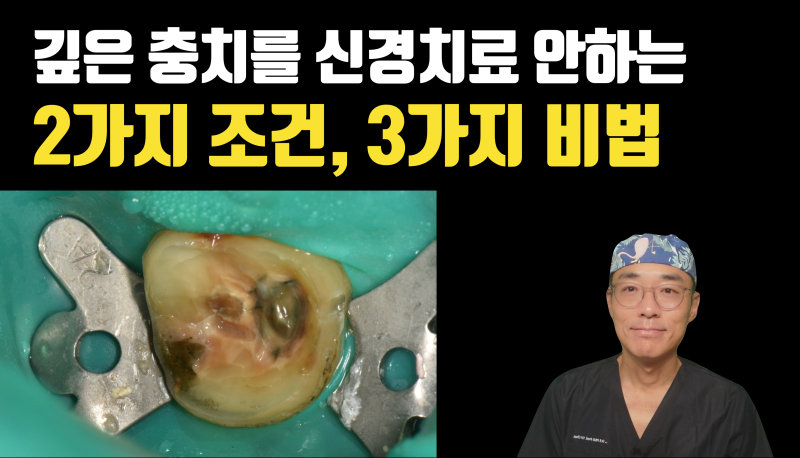 Gigi Berlubang Besar Tidak Selalu Memerlukan Perawatan Saluran Akar #ReimplantasiGigi #DrChoiYongHoon #PerawatanKeramik