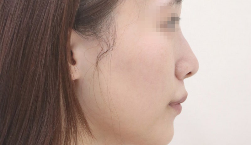 비주내리기, 비주함몰 비순각과 콧날개까지 살펴보는 이유
