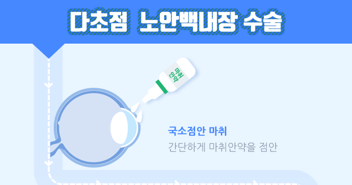 다초점 노안 백내장 수술이란? / 강남 스마일안과,강남 안과 추천