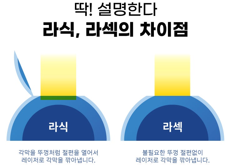운동선수 시력교정술 어떤 것이 적합할까?