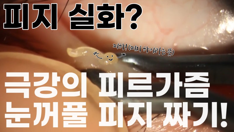 Eyelid Sebum Extraction! / Eyelid Sebum Extraction Goes Viral in Communities / Gangnam Smile Eye Clinic (feat. Pimple Popping Satisfaction)