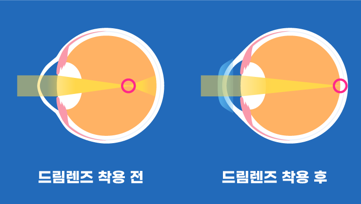 【강남스마일안과】 미성년자시력교정 가능한가요??