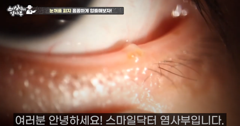 더 강력하게 돌아온 눈꺼풀 피지짜기 3! / ★★고름과 눈꺼풀피지를 한번에 뿌리까지 쫘아악★★