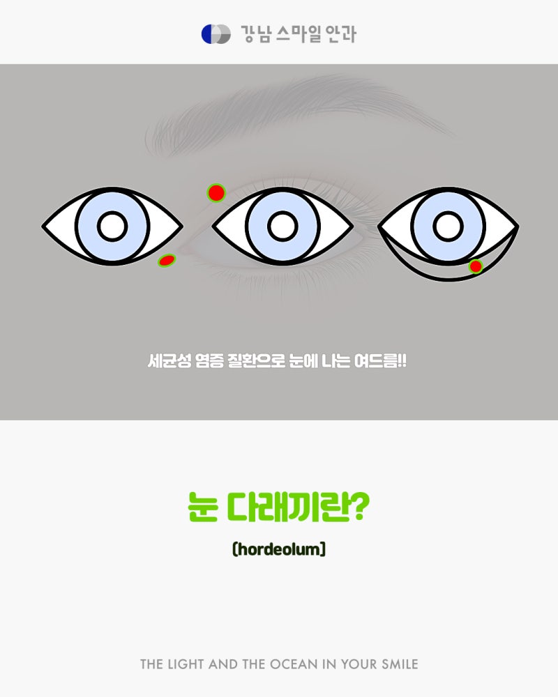 강남역 다래끼 치료 잘하는 곳을 찾고 있다면?