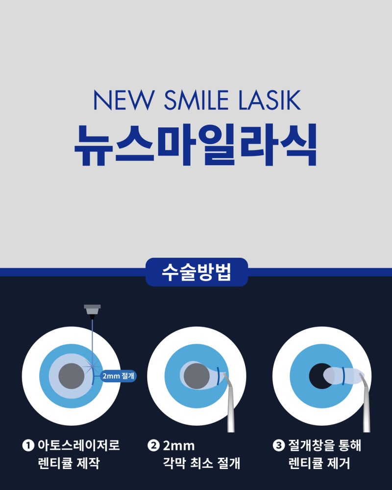 강남스마일안과 뉴스마일라식 효과와 안전성에 대해