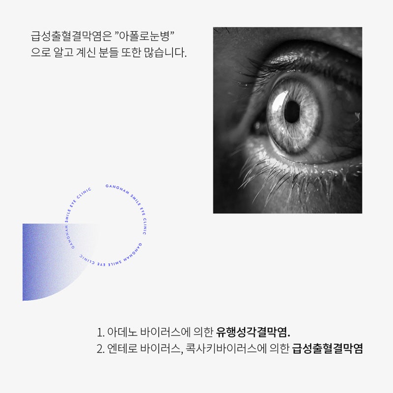 여름 휴가시즌 이후 궁금한 안질환?! 강남안과에서 체크:)