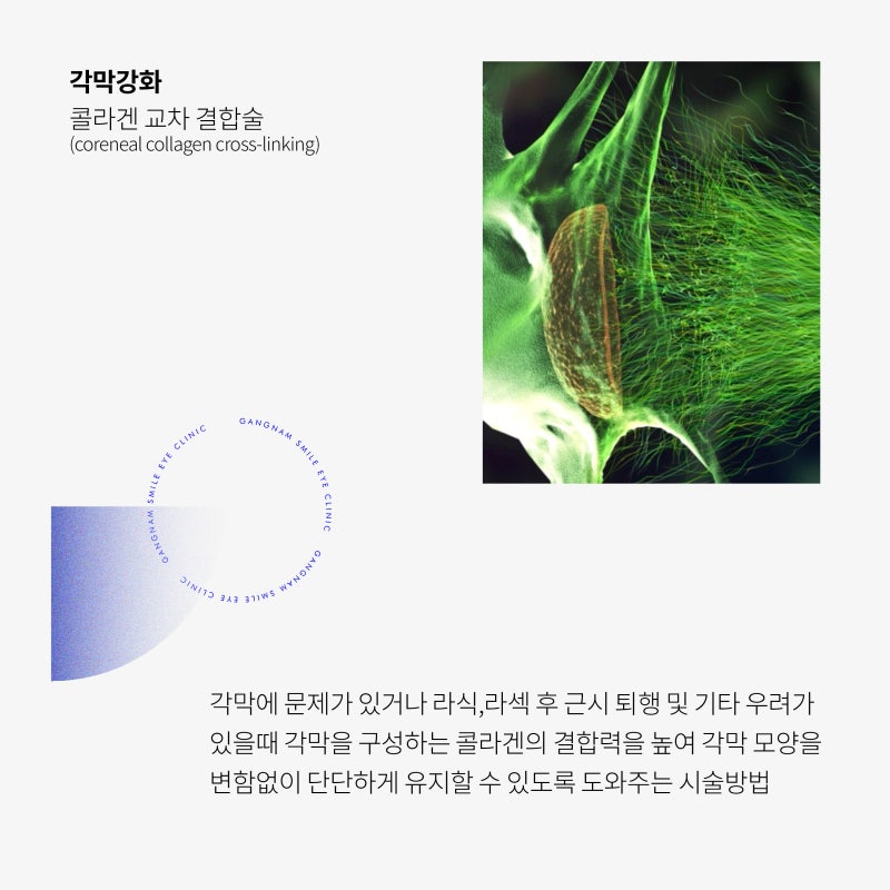 라식 라섹 수술, 각막강화술은 꼭 필요할까?