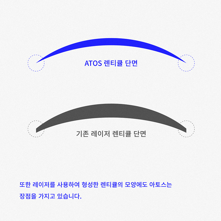 스마일수술의 가장 이상적인 형태