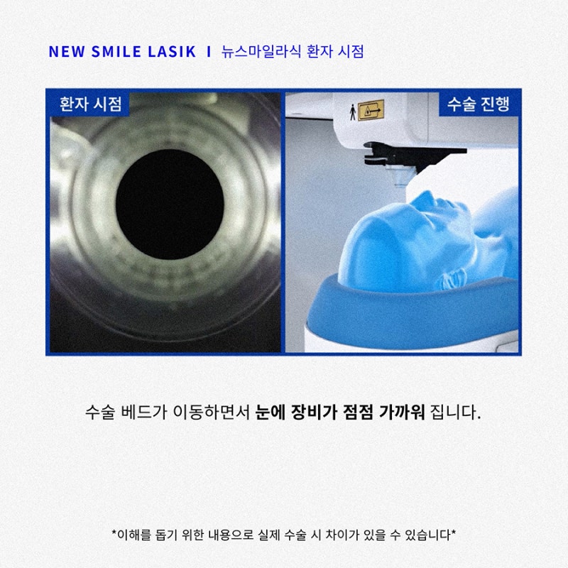 Sudut Pandang Pasien Operasi New Smile LASIK (Orang Pertama)