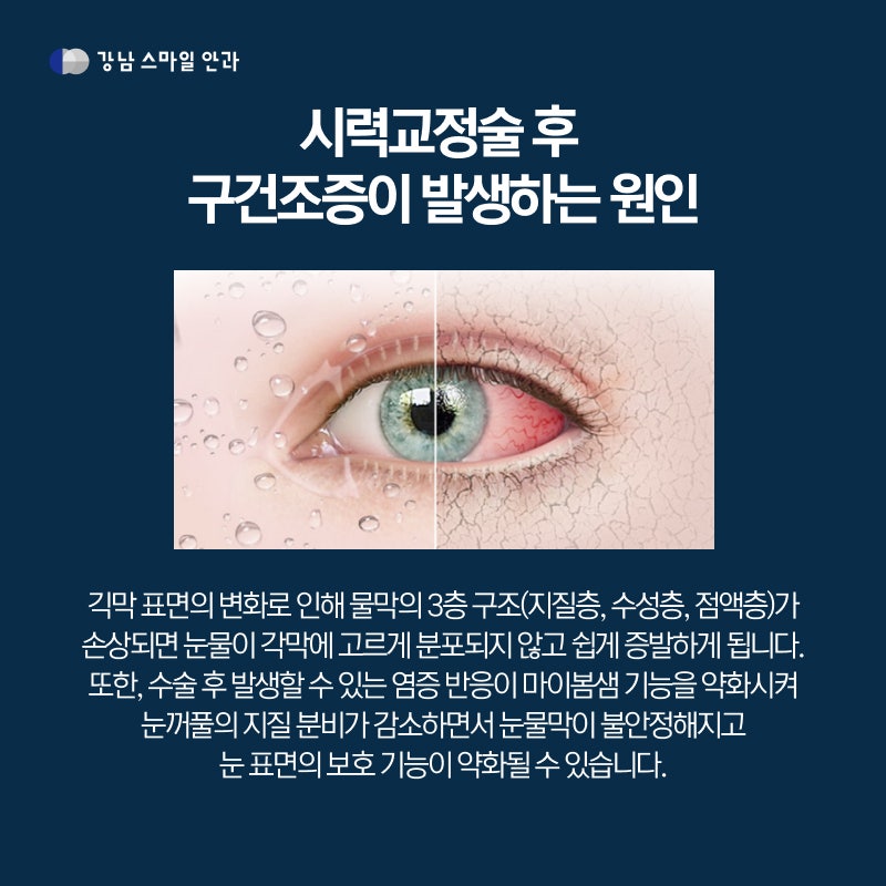 Worried about dry eyes? The reason for Today LASIK's popularity