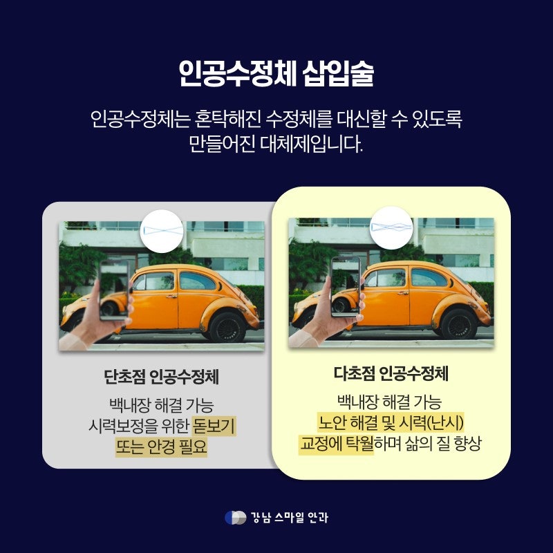 What is the Golden Time for Appropriate Cataract Surgery According to Cataract Type?