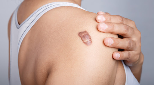 Apakah orang dengan keloid bisa menjalani LASIK atau LASEK?
