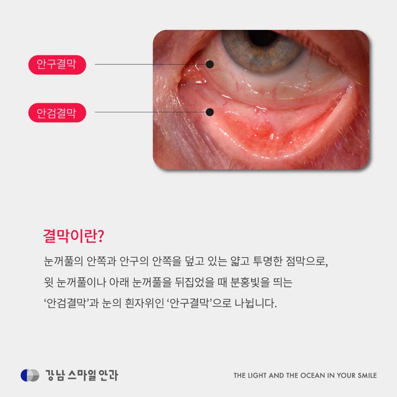 눈물, 이물감, 충혈 안구건조증 아닌 결막이완증? (결막이완증치료)