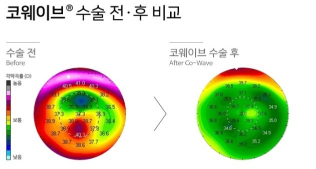 SMILE LASIK/LASEK减少副作用的方法,减少眩光的方法
